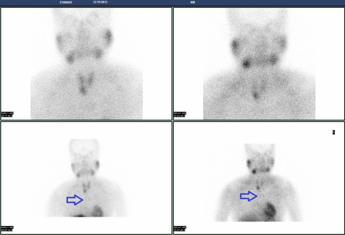 Figure 1: Preoperative SPECT/CT failed to detect paratracheal parathyroid gland