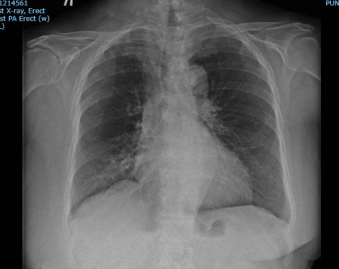 Picture 3: Chest X-ray at three months before central vein angioplasty