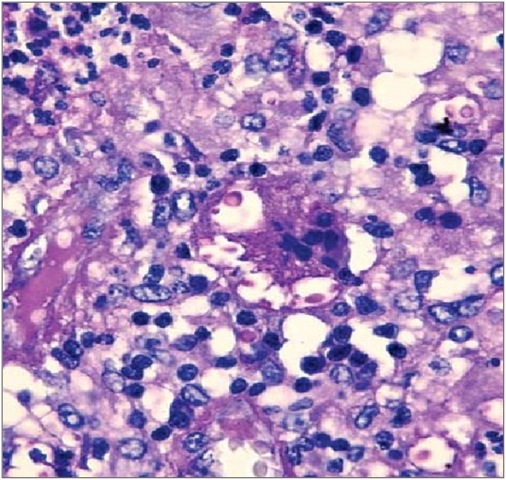 Histopathology of right parietal bone lesion showing fungal infection and osteomyelitis by Cryptococcus neoformans