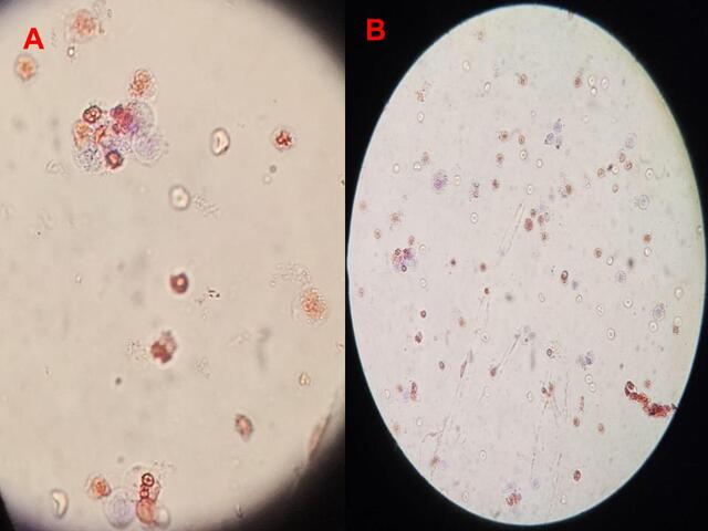 Figure 2: Urinary sediment