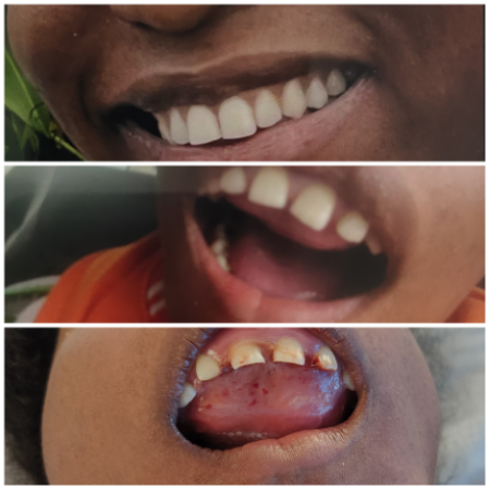 Brown tumour of palate