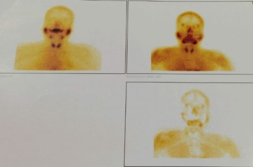 Fig.3 Technitium 99m Sestamibi Parathyroid scintigraphy scan suggestive of functioning parathyroid adenoma with no tracer uptake post parathyroidectomy