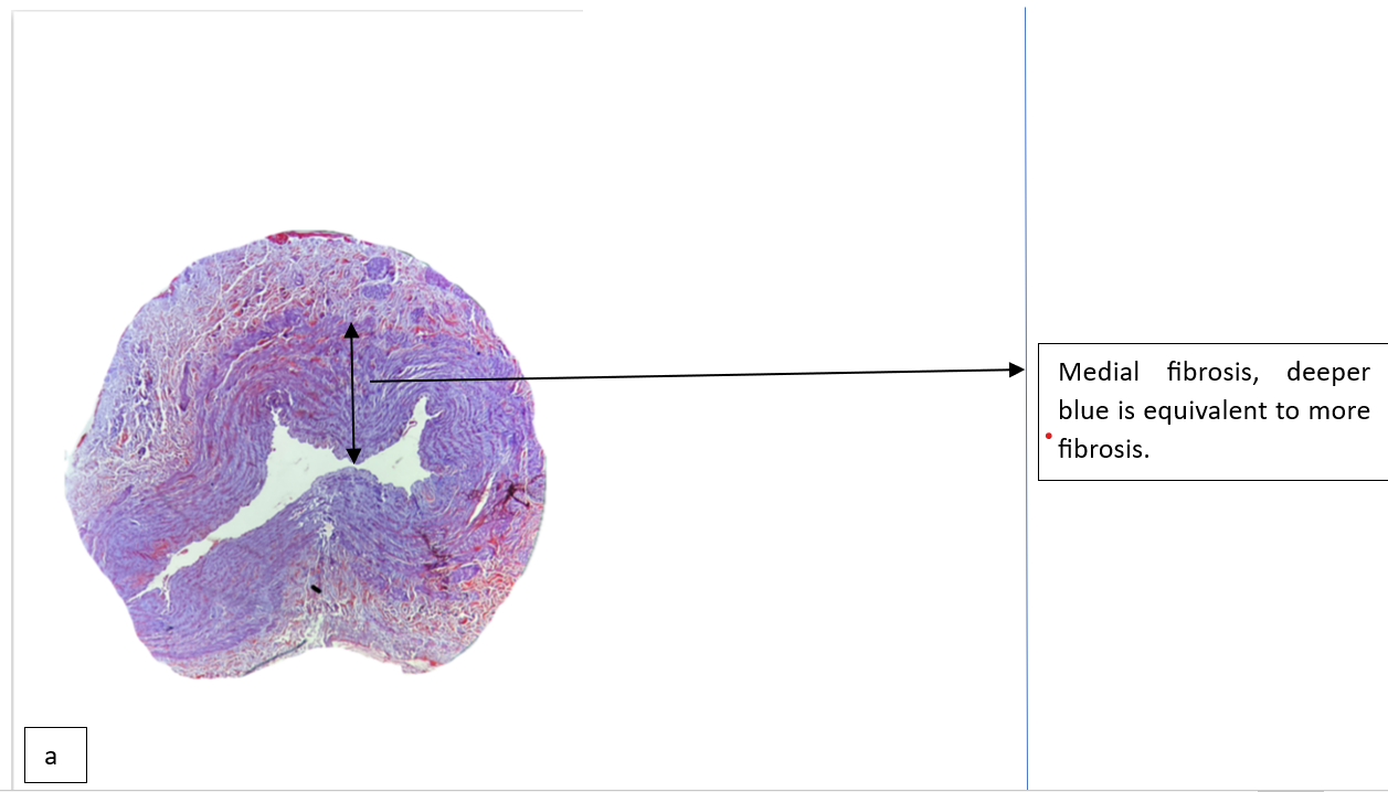 Figure 3a-Image a showing medial fibrosis in blue color areas, stain used MT (Masson-trichrome) in circumferential section leading to medial fibrosis.