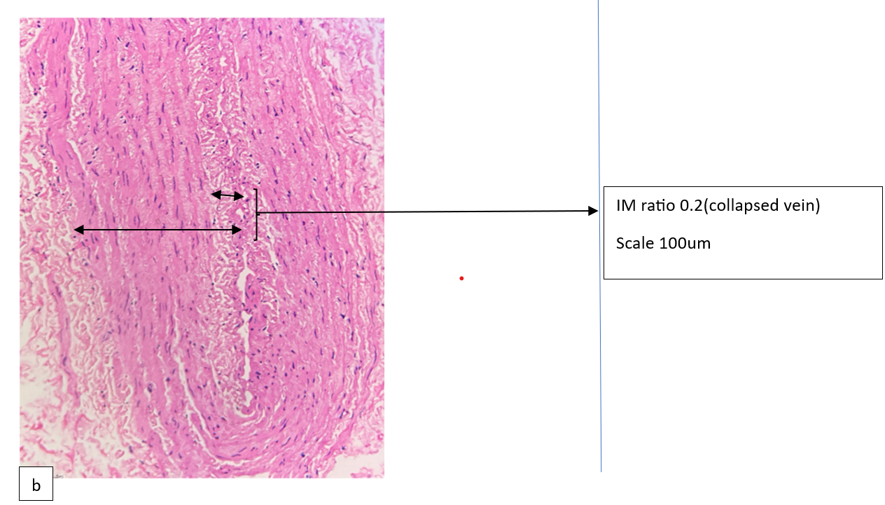 Figure 3b- luminal narrowing due to intimal hyperplasia, collapsed vein showing IM ration 0.2.