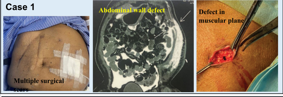 Laparoscopic port site leak