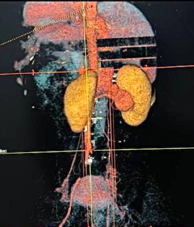 Renal angiogram demonstrating a hypertrophied right superior segmental artery supplying the bilobed aneurysm at the superior pole of the right kidney.
