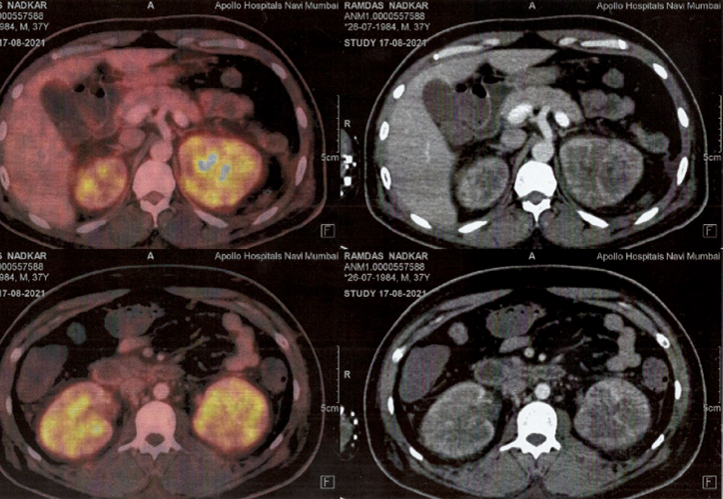 CASE 2 – 2.1a : PET scan revealing bulky kidneys with hypodense nodules.