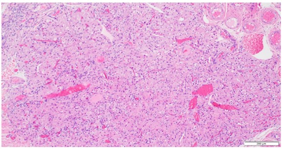 Figure 4. Photomicrograph of Hilus Leydig Cell Hyperplasia in Gonadal Section (H&E, 100×).
