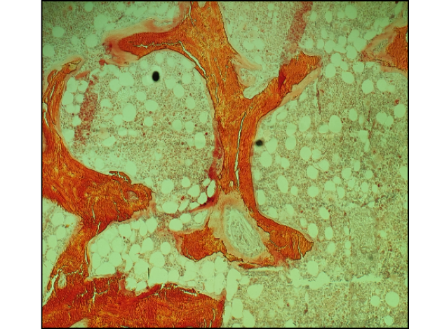 Figure 1: Image from one of our cases with positive aluminum stains as dark delineation at the osteoid-bone interface