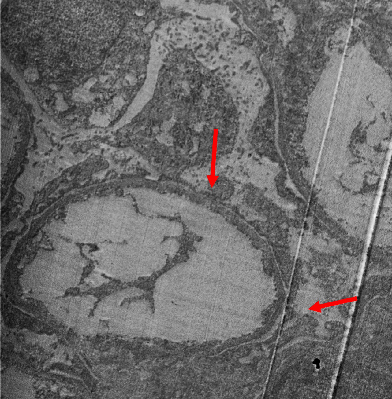 Figure 1: EM showing diffuse effacement of foot processes 100% (red arrow).