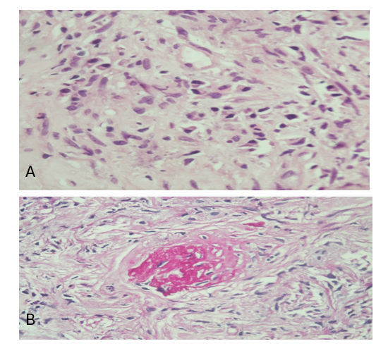 (A) Section reveal significant mature plasma cell infiltrate with admixed fibroblastic cells. The background interstitial fibrosis has storiform pattern (Hematoxylin & Eosin stain, x400) (B) Section reveal a glomerulus with fibrous crescent. There is rupture of bowman’s capsule indicating extracapillary proliferation(PAS stain, x400).