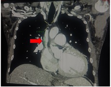 Figure 2. Contrast-enhanced CT scan of the chest, coronal view showing a non-occlusive mural thrombus (red arrow) within the superior vena cava, extending to the junction of the left innominate vein, measuring 5.7 cm x 1.4 cm x 0.7 cm (cephalocaudal, AP, transverse).
