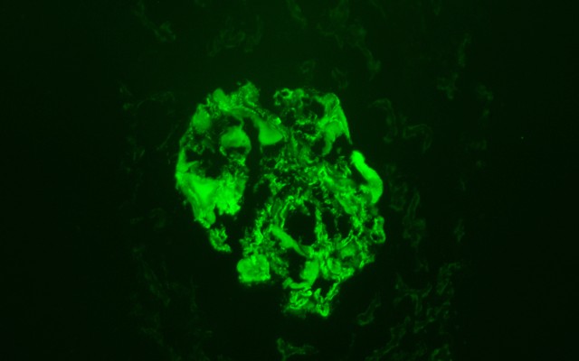 FIGURE 2(A) - Direct immunofluorescence study showed 2+/3+  granular staining of mesangial and capillary wall by IgG (IgG3+)