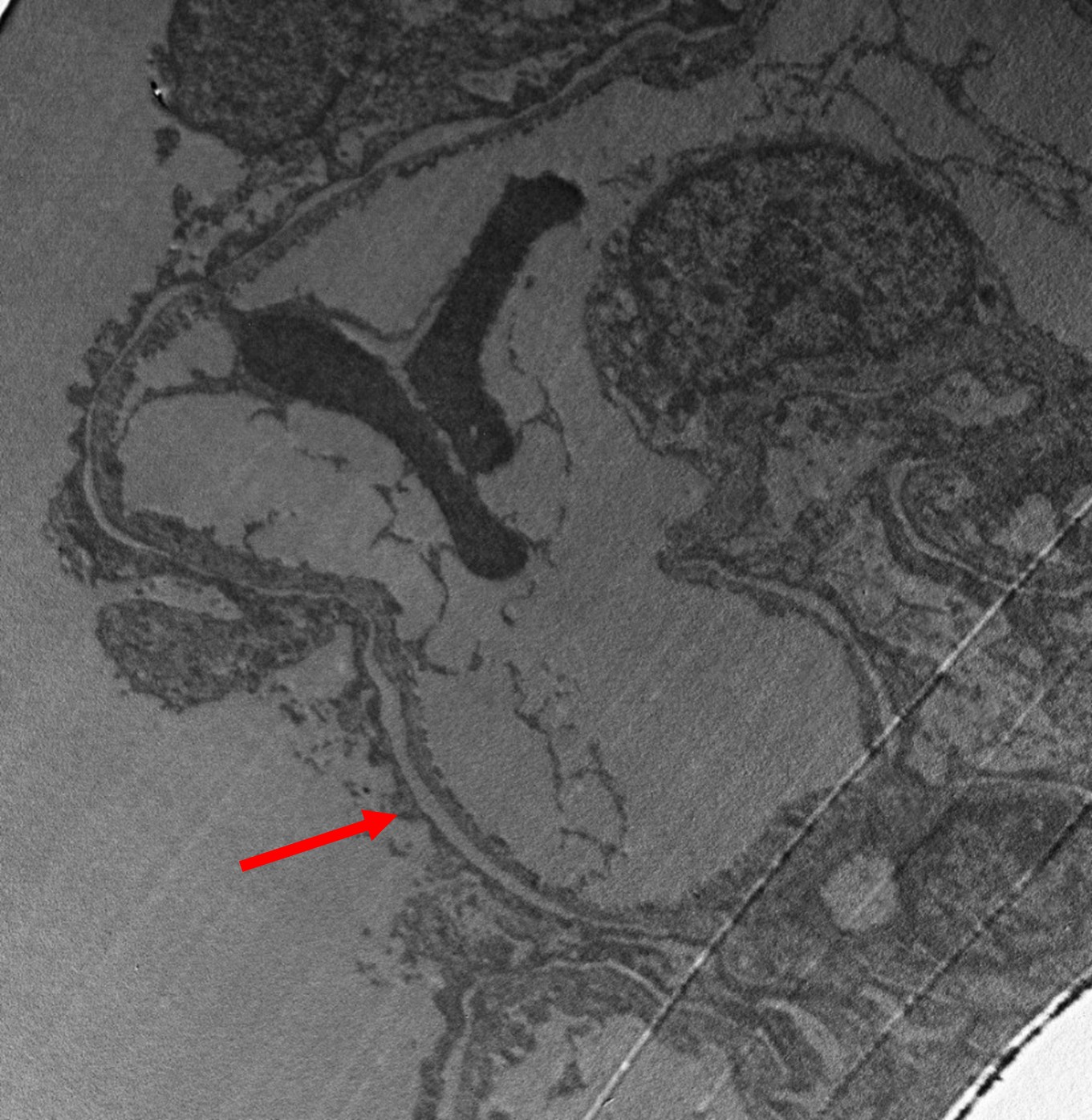 Figure 2: EM showing diffuse effacement of foot processes 100% (red arrow).