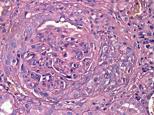 Hematoxylin and eosin (H&E) stain showing a glomerulus with a prominent cellular crescent and endocapillary hypercellularity.