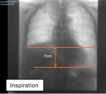 Picture 5: Fluoroscopy picture from Sniff Test during inspiration