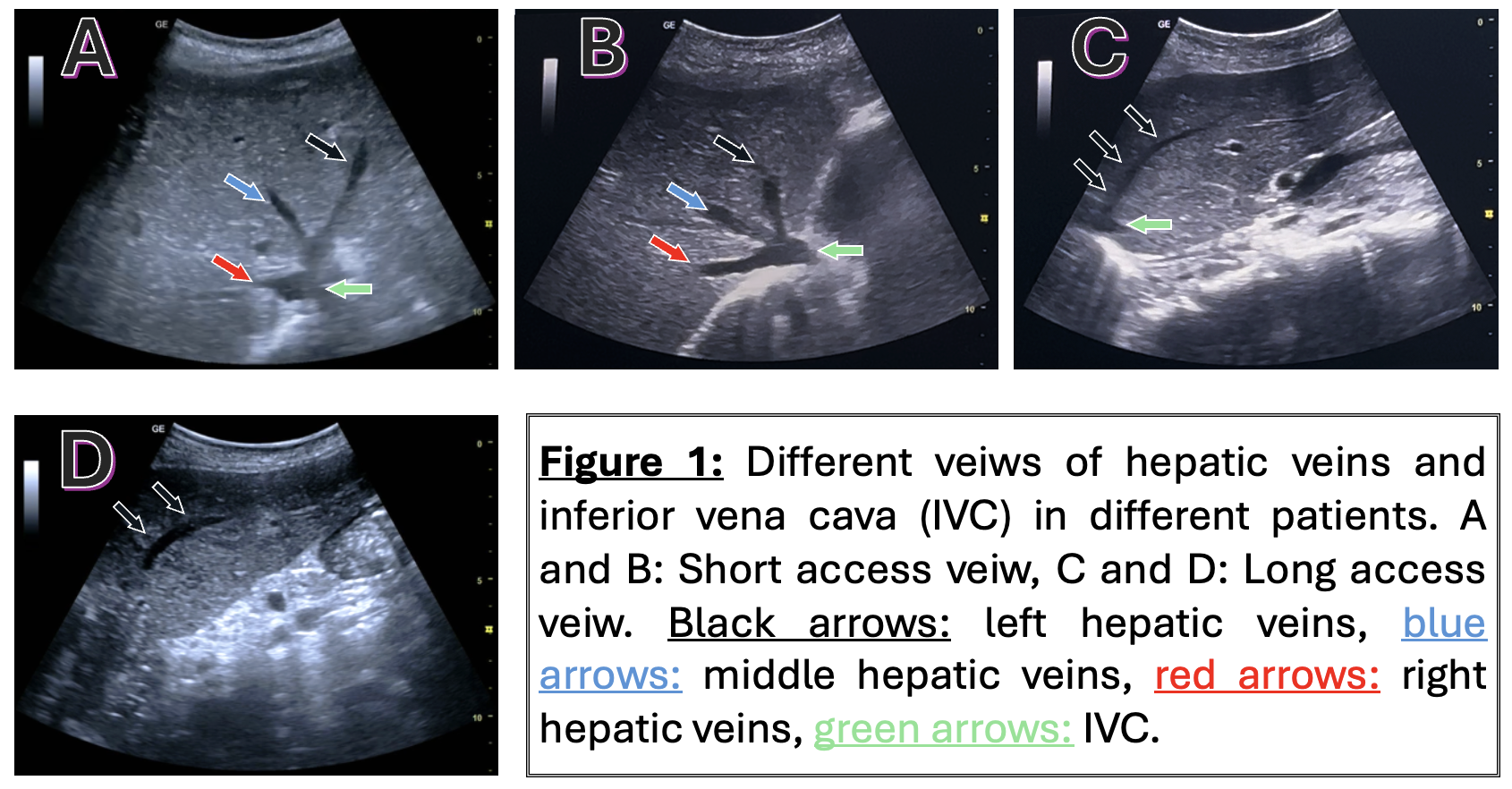 Figure 1: Different veiws of hepatic veins and inferior vena cava (IVC) in different patients. A and B: Short access veiw, C and D: Long access veiw. Black arrows: left hepatic veins, blue arrows: middle hepatic veins, red arrows: right hepatic veins, green arrows: IVC.