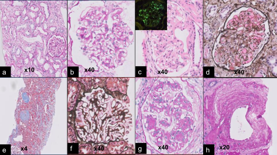 Figure 1: Photomicrographs of histologic lesions. (a) Periodic acid Schiff stain (PAS) (x10): Case of acute tubular injury. The section shows tubular injury with dilated lumina, loss of brush border, flattened and focally denuded epithelium; (b). PAS stain(x40): Case of minimal change disease, showing normal glomeruli with no increase in cellularity, basement membrane thickening, segmental sclerosis or crescents. (c.). Haematoxylin and Eosin stain (x40). IgA nephropathy case: mild mesangial expansion and hypercellularity. The insert shows immunofluorescence for IgA with mesangial coarse granular deposits of IgA. (d). PAS stain (x40): Case of thrombotic microangiopathy showing a glomerulus with fibrin thrombi within the capillary lumina. (e). Masson Trichrome stain (x4): Case of chronic tubulointerstitial nephritis, showing 2 sclerosed glomeruli, atrophic tubules, and interstitial inflammation and fibrosis. (g). Periodic acid silver methenamine stain (x40): Case of membranous nephropathy showing a glomerulus which had thickened capillary walls and subepithelial spikes. (h). Case of diabetic nephropathy, showing a glomerulus with prominent PAS-positive mesangial widening with Kimmelstiel-Wilson lesion. (g). PAS stain: Case of arteriosclerosis showing an artery with intimal fibrosis and duplication of the internal elastic lamina.