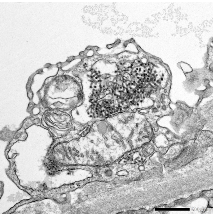 FIGURE 4: Renal Allograft Electron Microscopy- Viral Inclusion BK Virus Nephropathy