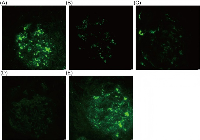 Figure 2 Renal Biopsy Histological findings. (A-E) Histological findings.Immunofluorescence:  (A)IgA(4+)，(B)IgM(3+),(C)C3(2~3+),(D)KAPPA(2+),(E)LAMDA(4+).