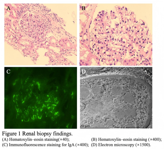 Figure 1 Renal biopsy findings. A: Hematoxylin-eosin staining (×40); B: Hematoxylin-eosin staining (×400); C: Immunofluorescence staining for IgA (×400); D: Electron microscopy (×1500).