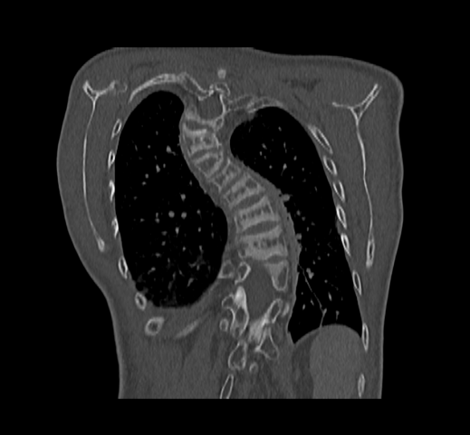 Dorsal scoliosis