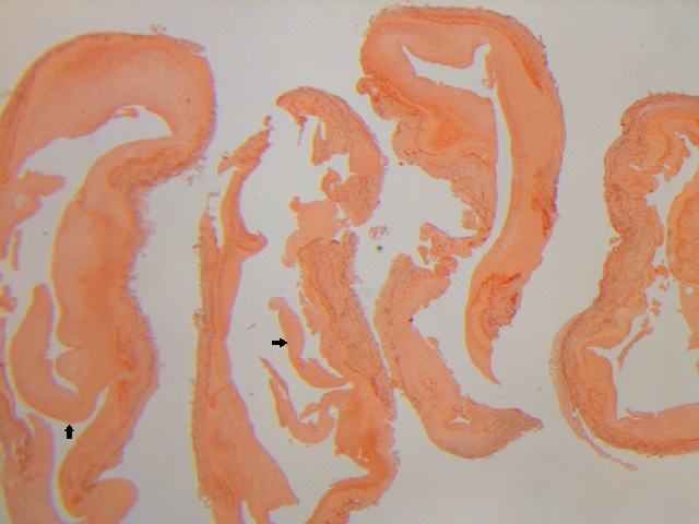 allograft fragmet