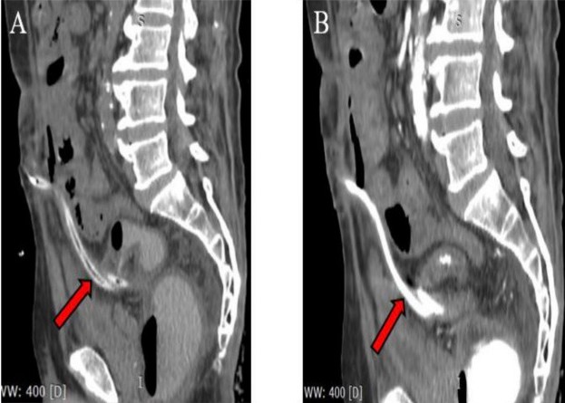 Figure 2. Abdominal CT scan, sagittal view, demonstrating the radiopaque (A) and hyperdense (B) PD catheter traversing the anterior abdominal wall and coursing through the peritoneal cavity at the level of the S3 vertebra (red arrows).
