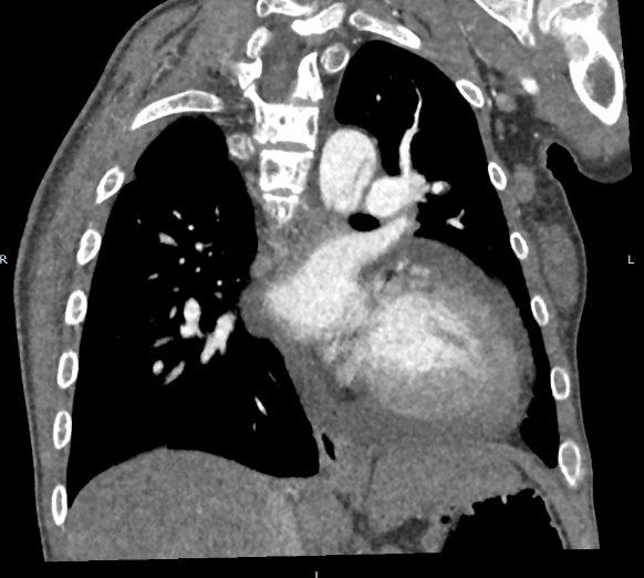 CT scans of the brain, abdominal and thoracic cavities were performed with contrast