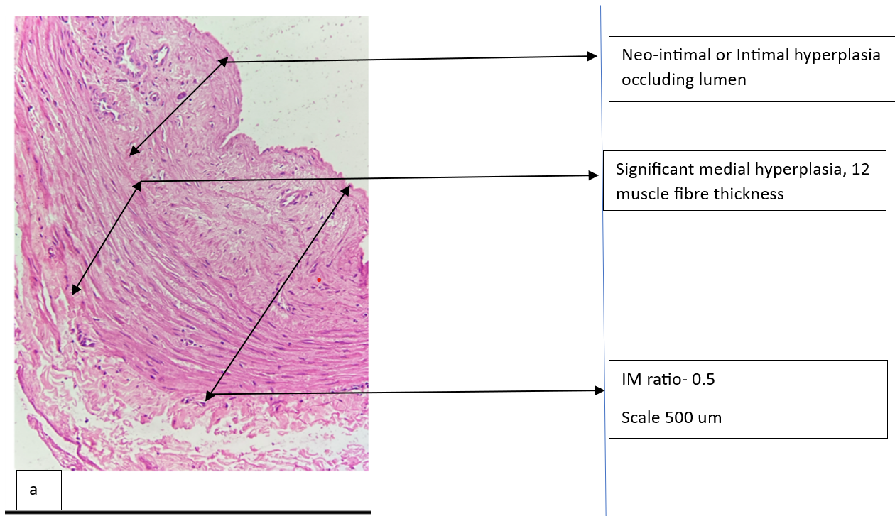 Figure 2a: Image showing  significant intimal hyperplasia protruding in lumen(Hematoxylin &Eosin stain).