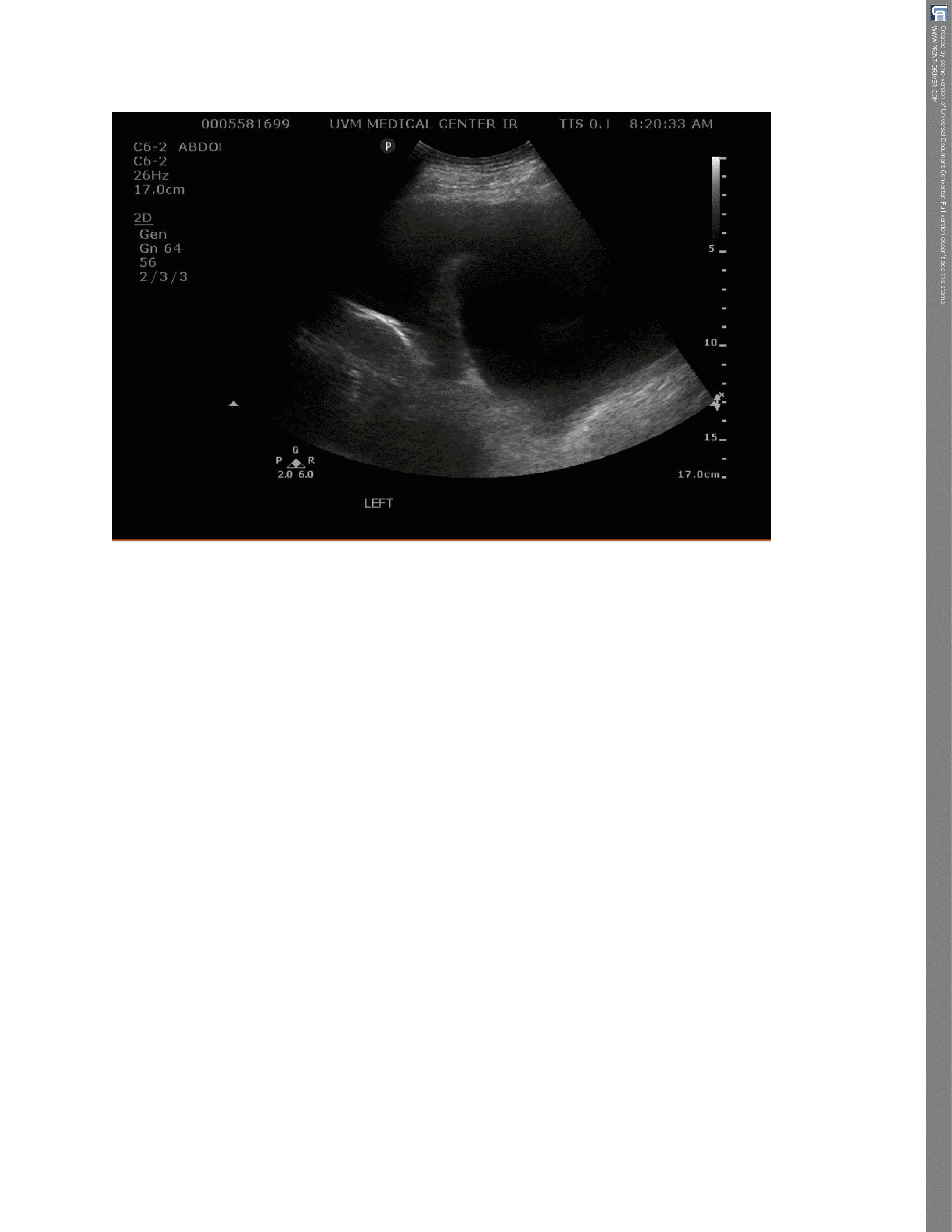 Left pleural effusion evident on ultrasound-guided thoracentesis in November 2024