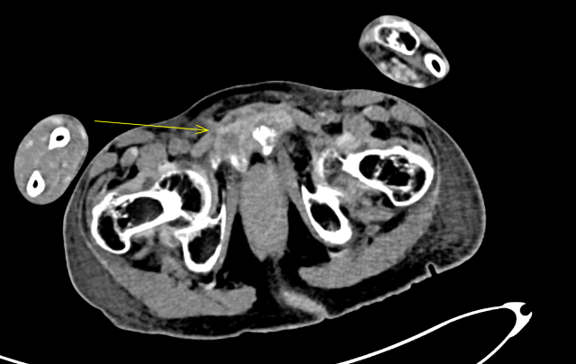Brown tumour of pubic bone