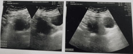 Fig. 1 Ultrasound of neck showing parathyroid adenoma in right inferior thyroid lobe.