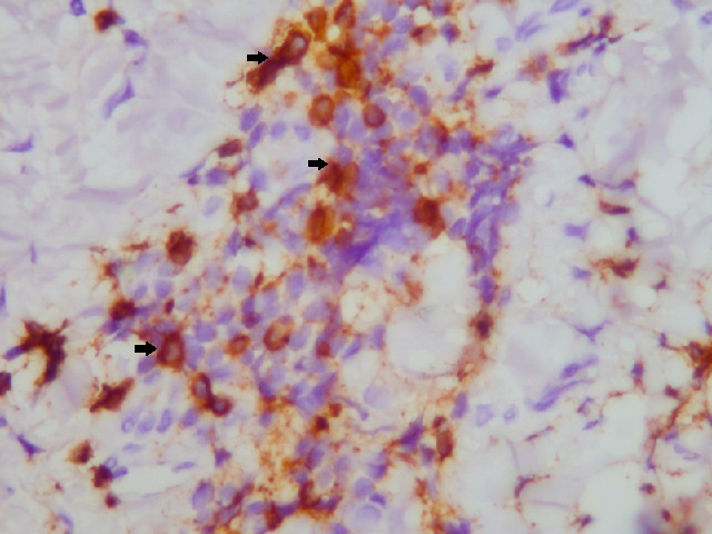 allograft fragment