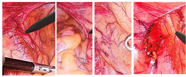 Figure 2. Intraoperative Laparoscopic View of Streak Gonads.