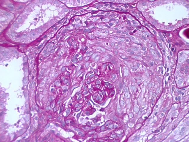 Periodic acid–Schiff (PAS) stain highlighting extracapillary proliferation and disruption of the glomerular basement membrane.