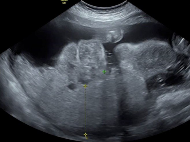 Figure 1. Pelvic Ultrasound of the patient at 21 weeks AOG showing placentomegaly. In January 2025, a placental thickness of 6.97 cm was observed, one of the criteria for mirror syndrome.