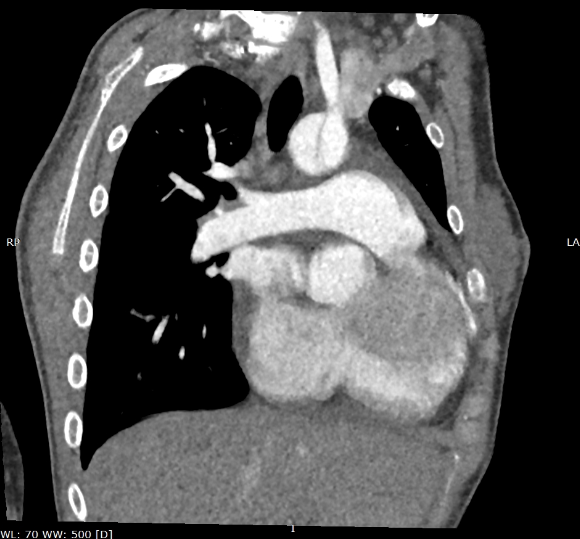 CT scan