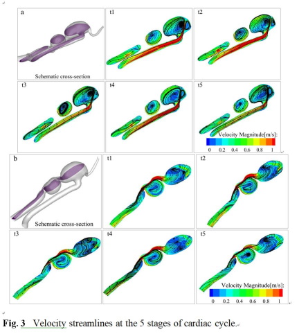Velocity streamlines at the 5 stages of cardiac cycle.