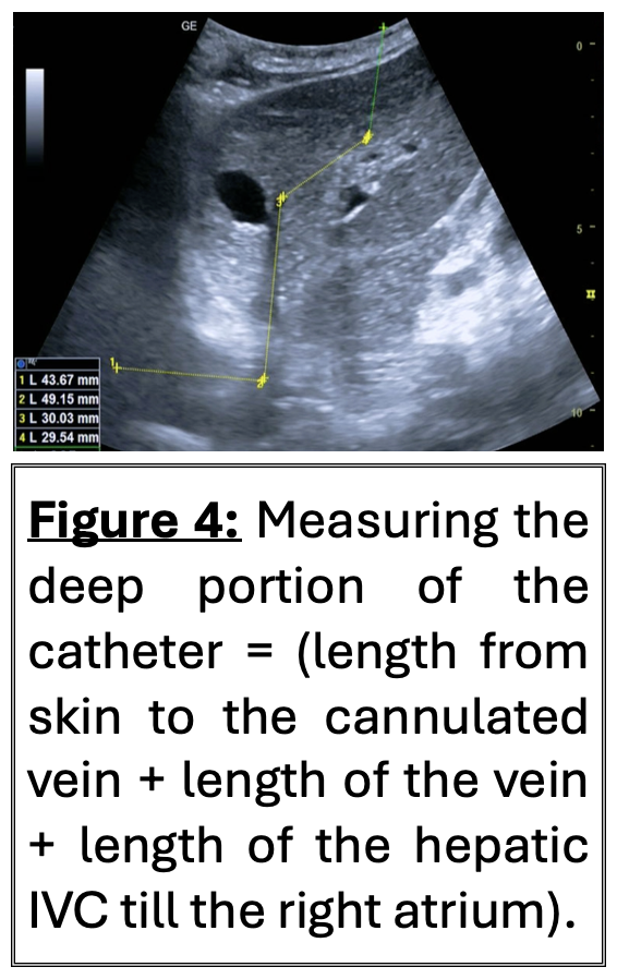 Figure 4: Measuring the deep portion of the catheter = (length from skin to the cannulated vein + length of the vein + length of the hepatic IVC till the right atrium).
