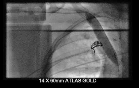 Picture 2: Post-angioplasty image demonstrating full balloon expansion indicating successful dilatation of the right innominate vein. i