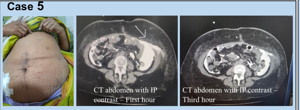 Subcutaneous leak