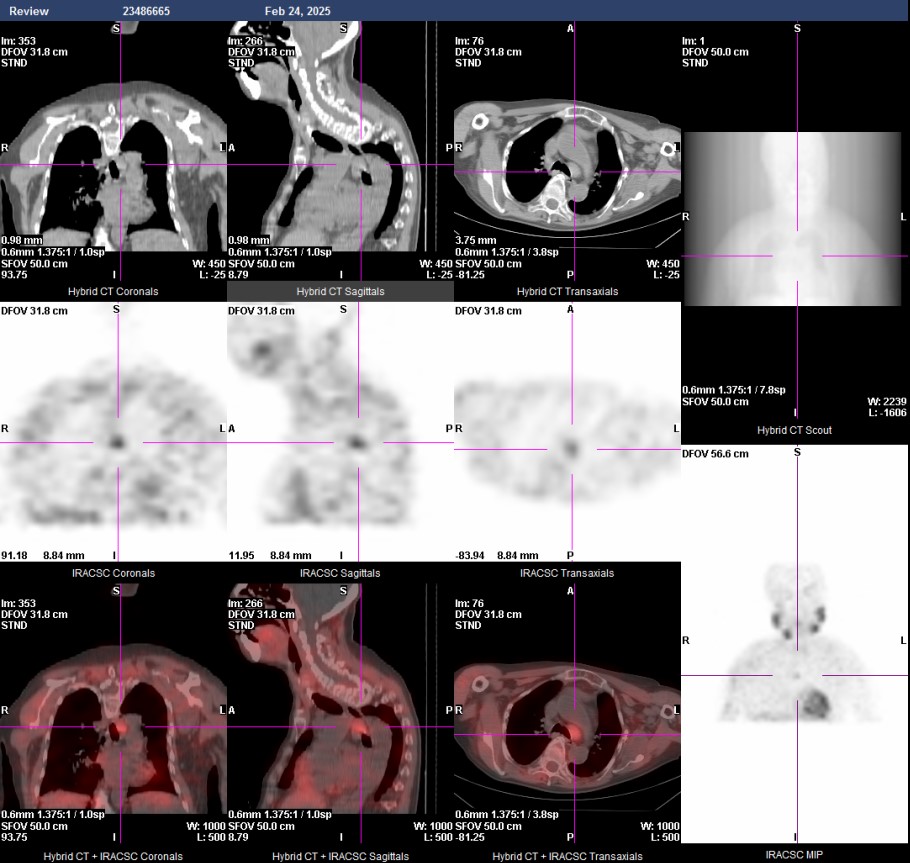 A repeated SPECT/CT scan performed 11 years later demonstrated radionuclide uptake at the hypertrophied ectopic paratracheal parathyroid gland.