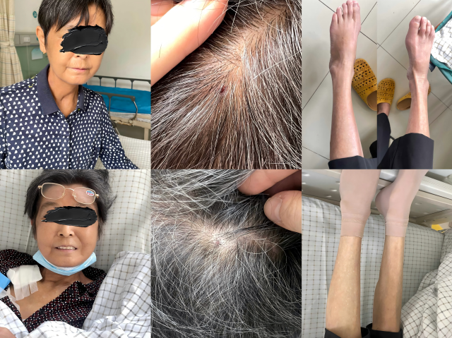 The upper image shows the patient's condition before treatment, with excoriations and skin breakdown on the scalp, as well as erythema and scratch marks on the skin of both lower limbs. The lower image demonstrates the patient's condition after one week of treatment, showing healed scalp lesions with detached scabs, absence of new excoriations, and resolution of erythema and scratch marks on both lower limbs.
