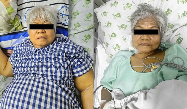 Marked jaundice resolution after three sessions of DPMAS in severe DILI (left: pre-treatment, right: post-treatment)