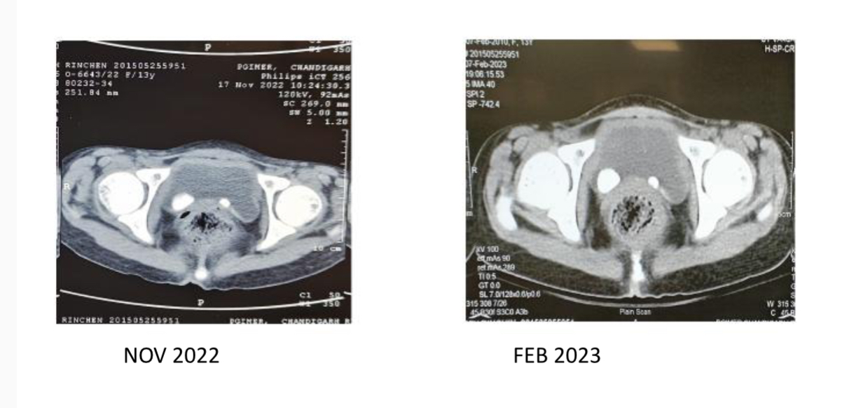 NCCT KUB showed two hyperdense lesions in the bladder ?calculi.