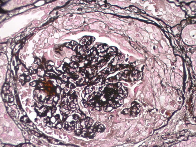 Jones methenamine silver stain revealing a well-formed cellular crescent with preserved capillary loops and focal basement membrane irregularities.