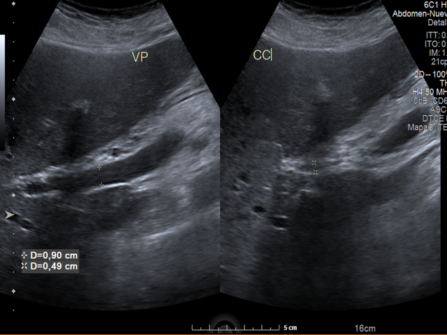 Figure 1: Abdominal ultrasound showing no biliary obstruction.