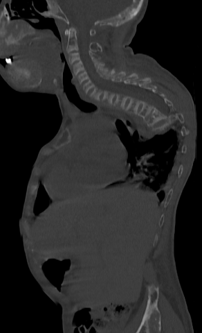 Dorsal kyphosis