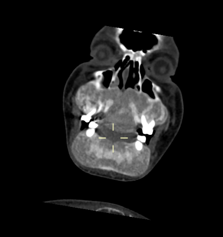 Brown tumour of maxilla and mandible